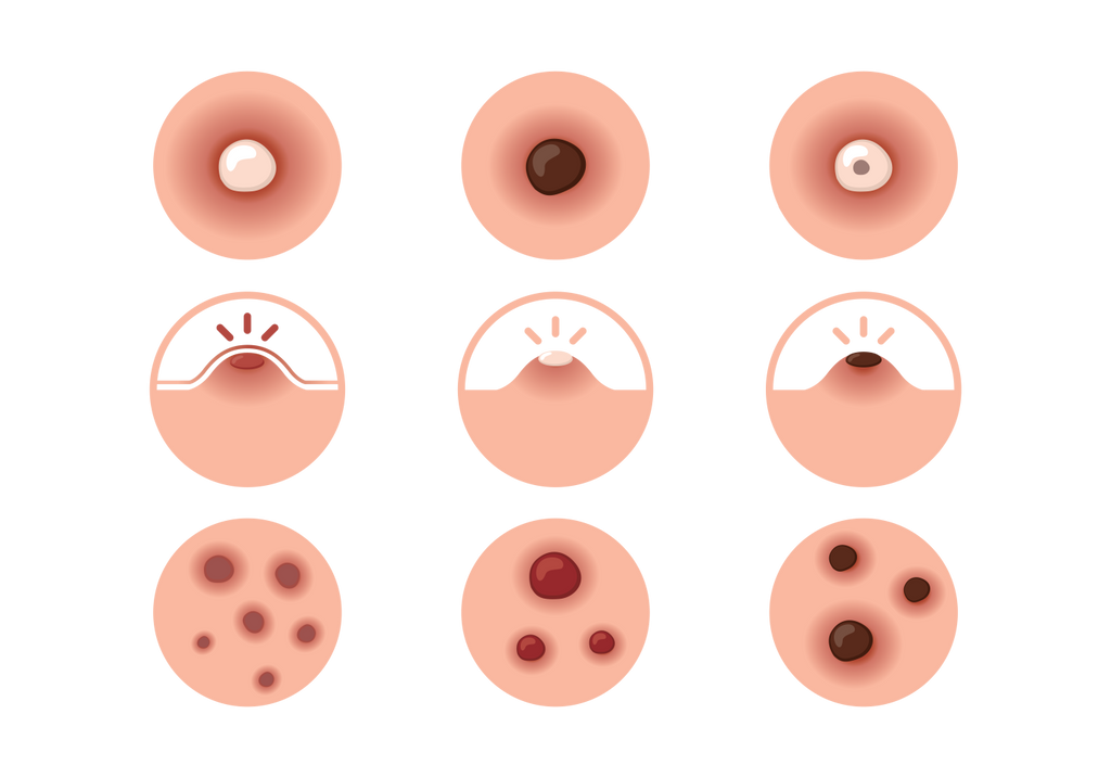 types of pimples